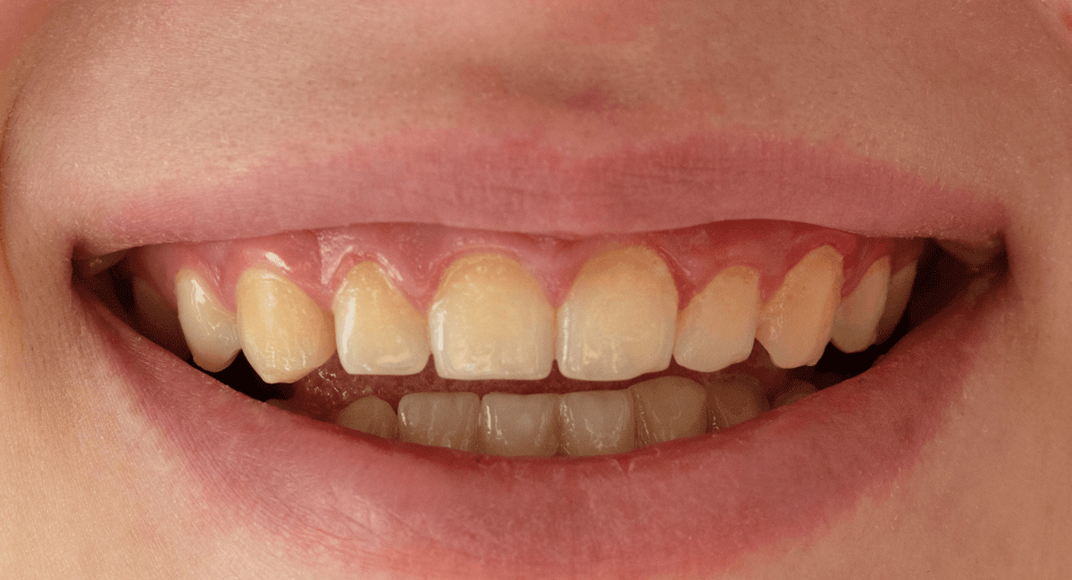 are-the-teeth-yellow-even-after-daily-brushing-know-the-reasons-behind-this