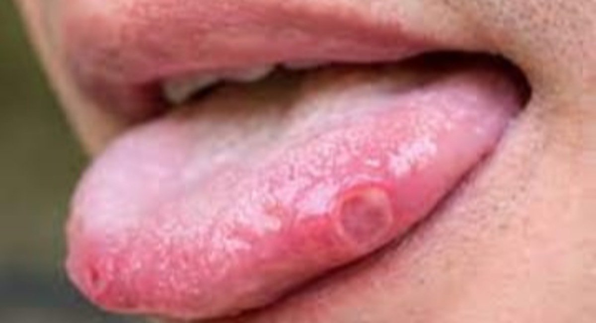 Mouth Cancer: నోటిపూతను లైట్ తీసుకుంటున్నారా? క్యాన్సర్ కావచ్చు జర జాగ్రత్త! mouth sores warning cancer know symptoms of mouth cancer