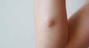 body fat lumps causes symptoms danger treatment know more details