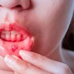 Mouth Cancer: నోటిపూతను లైట్ తీసుకుంటున్నారా? క్యాన్సర్ కావచ్చు జర జాగ్రత్త!