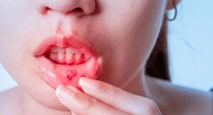 Mouth Cancer: నోటిపూతను లైట్ తీసుకుంటున్నారా? క్యాన్సర్ కావచ్చు జర జాగ్రత్త!