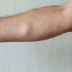 Fat Lumps: శరీరం పై కొవ్వు గడ్డలు ఉన్నాయా? ఇవి ప్రమాదమా? లక్షణాలు ఇవే!